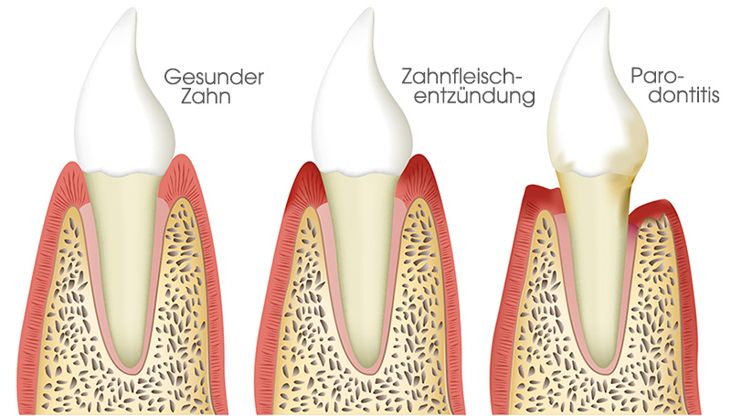 Gesunder Zahn, Zahnfleischentzündung, Parodontitis bei rheumatoider Arthritis